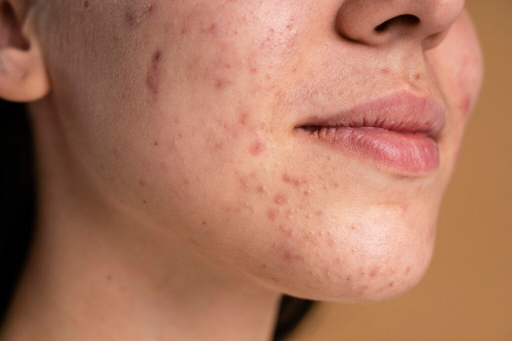 Comment éviter les boutons liés au cycle menstruel ?
